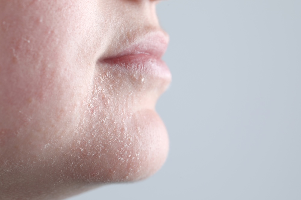Woman with dry skin on face against light grey background, closeup. Space for text
